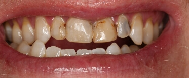 porcelain-crowns-before